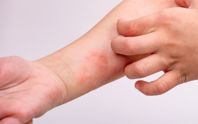 Restoring Balance to Eczema Prone Skin